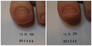 leczenie wrastających paznokci gorzów 3
